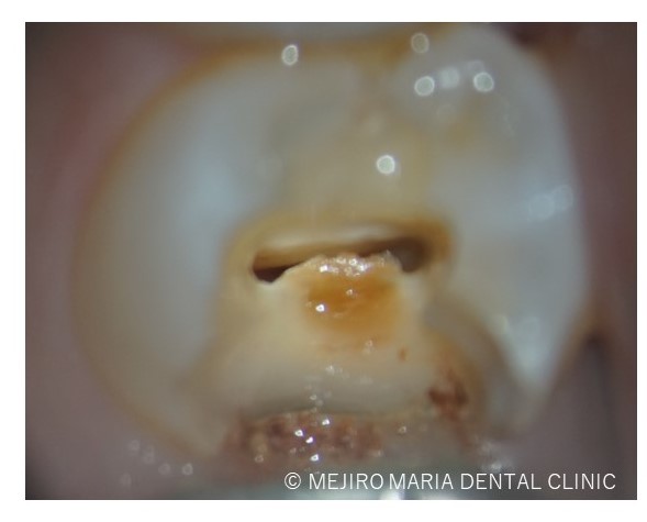 目白マリア歯科【症例】精密根管治療による複雑な根管形態へのアプローチ_治療詳細_口腔内写真