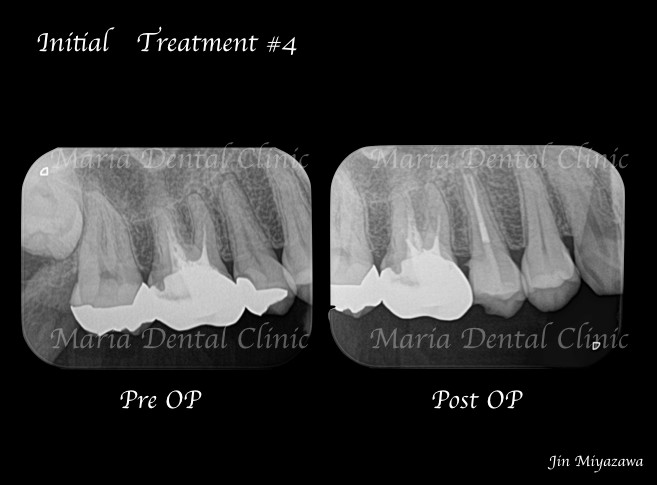 目白マリア歯科【症例】精密根管治療による複雑な根管形態へのアプローチ_術前術後レントゲン画像比較