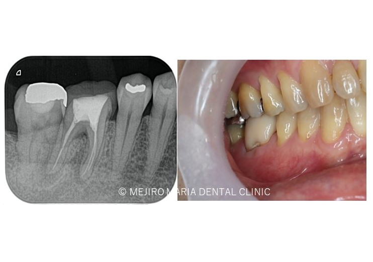 目白マリア歯科の精密根管治療症例画像0191116