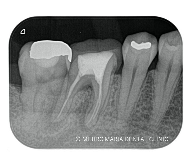 目白マリア歯科の精密根管治療症例術前レントゲン写真と口腔内写真20191116