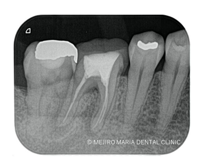 目白マリア歯科の精密根管治療症例術レントゲン後画像0191116