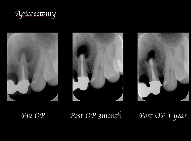 目白マリア歯科_コラム_歯根端切除術後の経過観察の重要性ー患者様利益の為にできること（院長宮澤）_歯根端切除術症例画像2-1