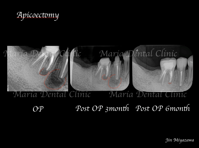 目白マリア歯科_コラム_歯根端切除術後の経過観察の重要性ー患者様利益の為にできること（院長宮澤）_歯根端切除術症例画像2