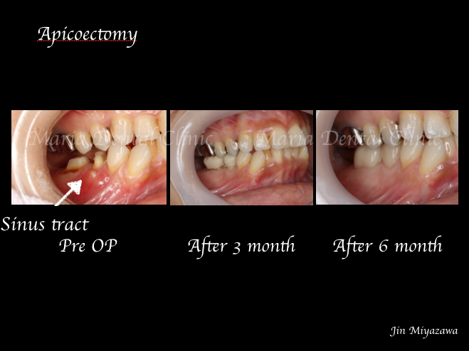目白マリア歯科_コラム_歯根端切除術後の経過観察の重要性ー患者様利益の為にできること（院長宮澤）_歯根端切除術症例画像3