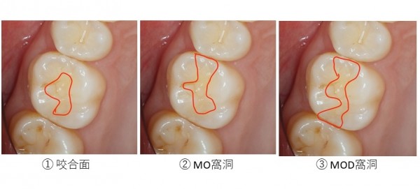 目白マリア歯科_コラム_虫歯処置後の補綴物（詰め物）の考え方、材料ごとの利点欠点＿①レジン（院長宮澤）_どの程度歯を削ると歯の強度は下がってしまうのか前提