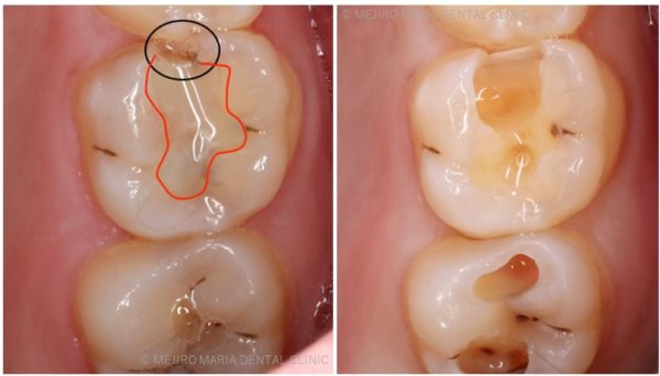 目白マリア歯科_コラム_虫歯処置後の補綴物（詰め物）の考え方、材料ごとの利点欠点＿①レジン（院長宮澤）_歯科治療補綴物レジンがかける、虫歯ができる