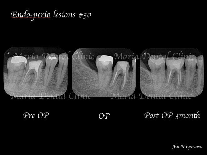 目白マリア歯科【症例】歯根破折を疑わせる症例（治療チャレンジにより抜歯を回避）_レントゲン画像術前術後の比較