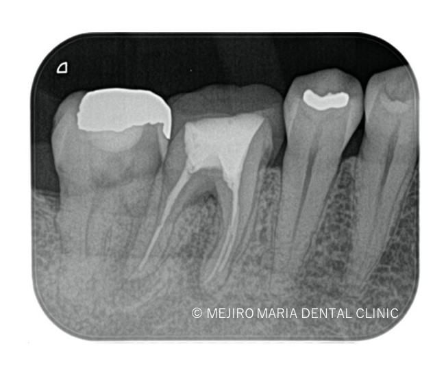 目白マリア歯科【症例】歯根破折を疑わせる症例（治療チャレンジにより抜歯を回避）_治療後_治療後1ヶ月のレントゲン画像