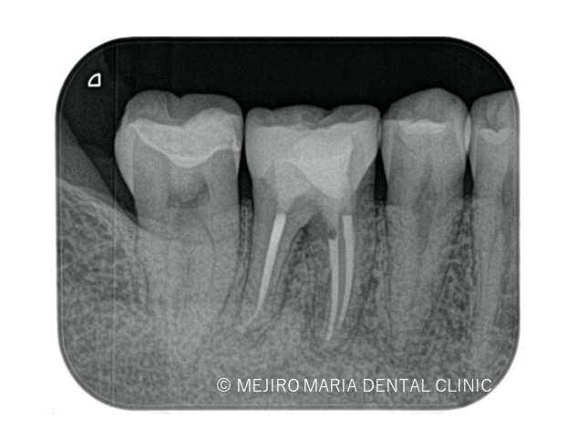 目白マリア歯科【症例】歯根破折を疑わせる症例（治療チャレンジにより抜歯を回避）_治療後_治療後3ヶ月のレントゲン画像
