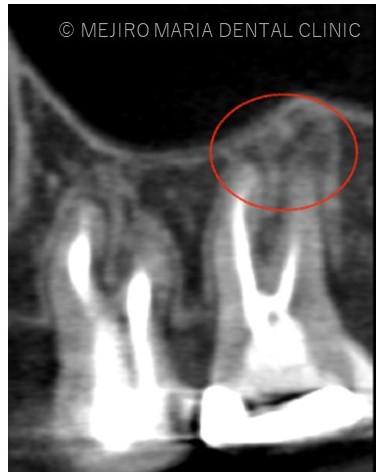 目白マリア歯科1214再根管治療症例治療前CT画像