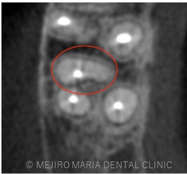目白マリア歯科1214再根管治療症例治療前CT画像