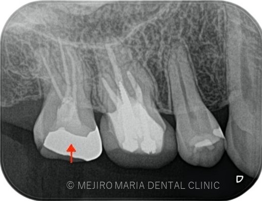 目白マリア歯科1214再根管治療症例治療前画像