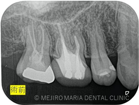 目白マリア歯科1214再根管治療症例治療後レントゲン画像