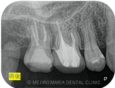 目白マリア歯科1214再根管治療症例治療後レントゲン画像