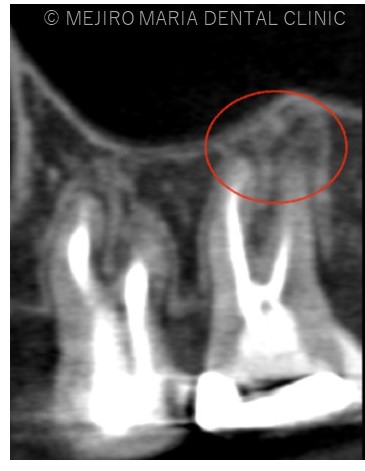 目白マリア歯科1214再根管治療症例治療詳細CT画像
