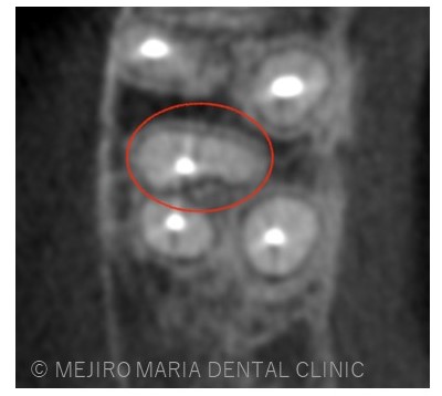 目白マリア歯科1214再根管治療症例治療詳細CT画像
