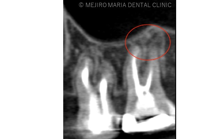 目白マリア歯科【症例】再根管治療｜ CT、マイクロスコープを使った精密根管治療_治療前_レントゲン画像2