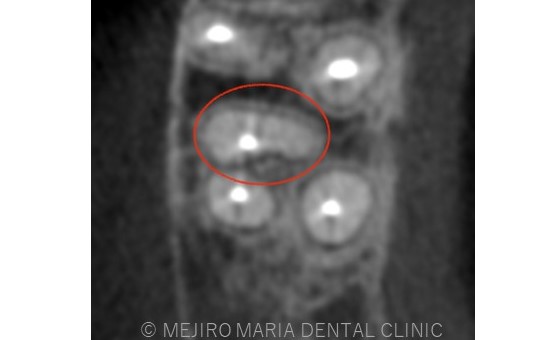 目白マリア歯科【症例】再根管治療｜ CT、マイクロスコープを使った精密根管治療_治療前_レントゲン画像3