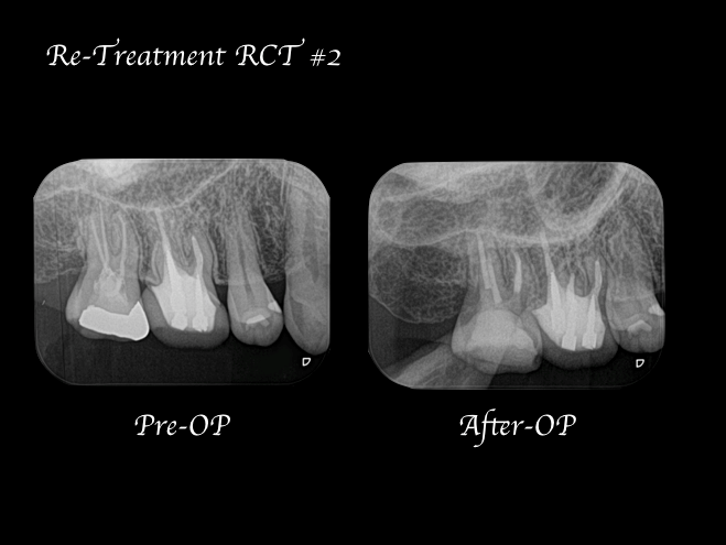 目白マリア歯科【症例】再根管治療｜ CT、マイクロスコープを使った精密根管治療_術前術後のレントゲン比較画像