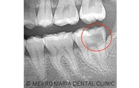 目白マリア歯科0125生活歯髄切断法を用いた歯の神経の保存症例治療前レントゲン画像