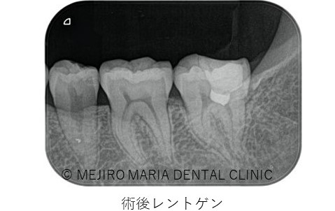目白マリア歯科0125生活歯髄切断法を用いた歯の神経の保存症例術後レントゲン画像