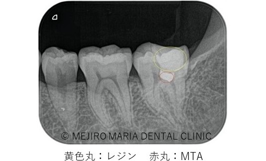目白マリア歯科0125生活歯髄切断法を用いた歯の神経の保存症例術後レントゲン画像とレジン、MTA部分