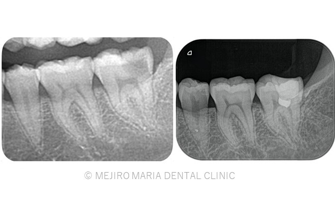 目白マリア歯科【症例】生活歯髄切断法を用いて歯髄保存した症例−歯の神経を保存できる虫歯処置− _メイン_治療前後のレントゲン画像