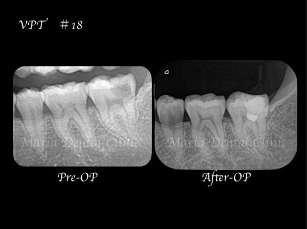 目白マリア歯科【症例】生活歯髄切断法を用いて歯髄保存した症例−歯の神経を保存できる虫歯処置− _治療詳細_術前術後レントゲン画像