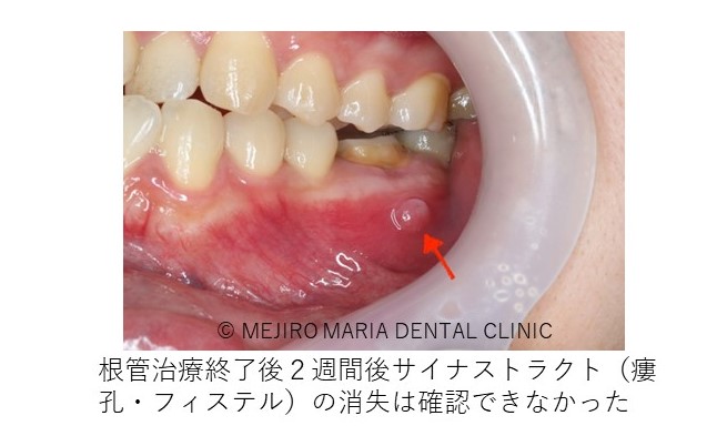 症例 歯根端切除術により抜歯を覚悟していた歯の保存に成功 目白マリア歯科 目白 下落合の歯医者 症例 歯根端切除術により抜歯を覚悟していた歯の保存に成功 目白マリア歯科 目白 下落合の歯医者