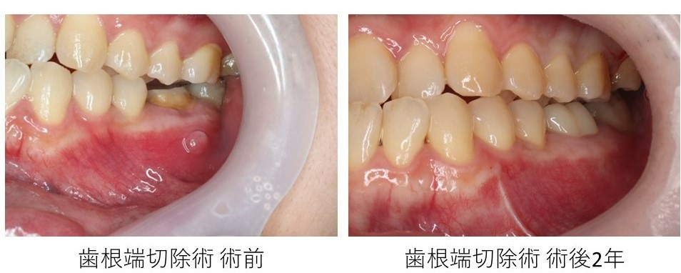 目白マリア歯科【症例】歯根端切除術により抜歯を覚悟していた歯の保存に成功_術前術後の比較画像