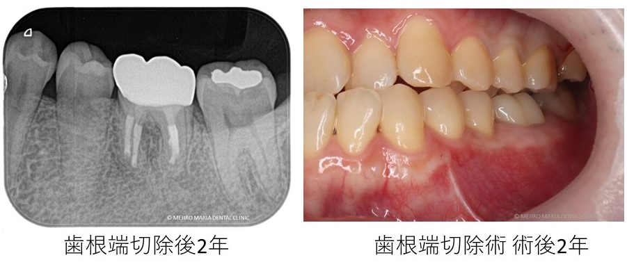 歯根端切除後2年経過観察時の口腔内画像、レントゲン画像｜目白マリア歯科