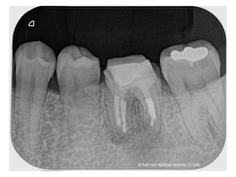 歯根端切除術症例歯根端切除術直後レントゲン画像｜目白マリア歯科