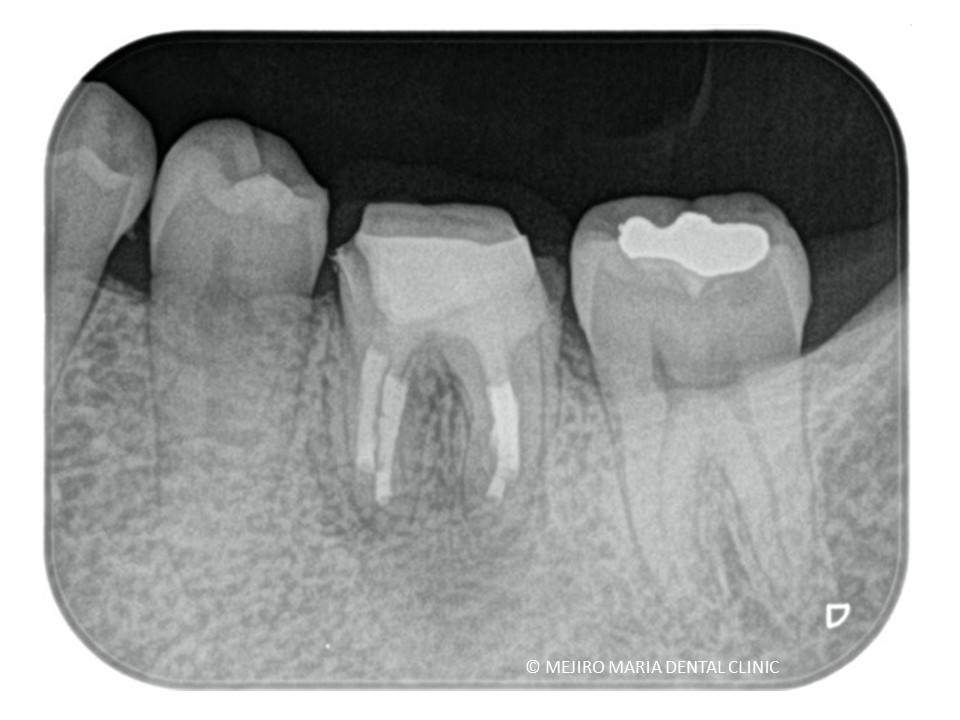 歯根端切除術症例歯根端切除術３か月後レントゲン画像｜目白マリア歯科