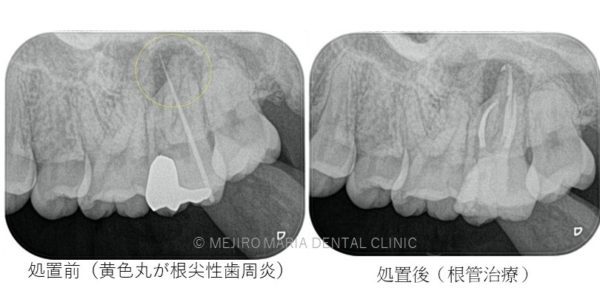 目白マリア歯科 根尖性歯周炎症例写真