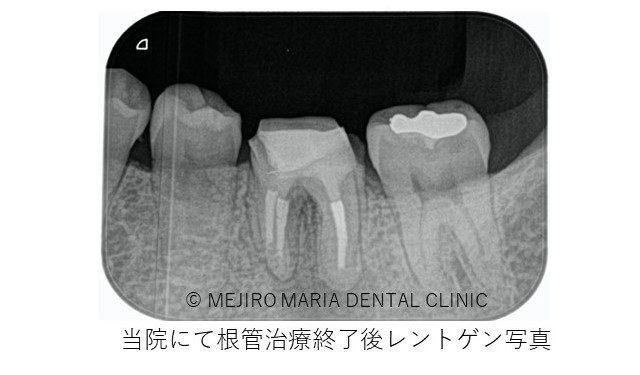 目白マリア歯科 歯根端切除術症例治療中レントゲン画像