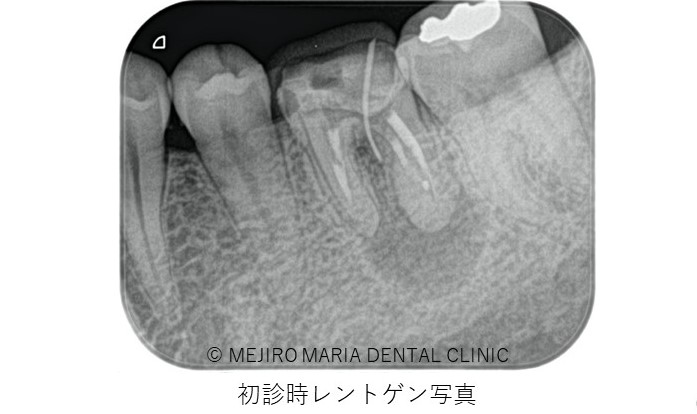 目白マリア歯科 歯根端切除術症例治療前レントゲン画像