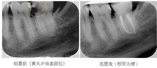 目白マリア歯科_コラム_虫歯治療のステージと治療法（院長宮澤）_コンポジットレジン修復目白マリア歯科_コラム_虫歯治療のステージと治療法（院長宮澤）_根管治療
