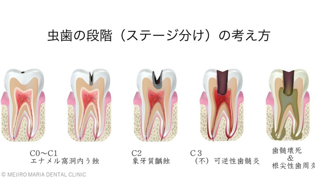 目白マリア歯科_コラム_虫歯治療のステージと治療法（院長宮澤）_虫歯のステージの模式図-1