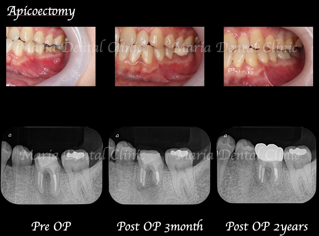 【症例】歯根端切除術により抜歯を覚悟していた歯の保存に成功_術前術後、経過観察の口腔内画像とレントゲン画像｜目白マリア歯科
