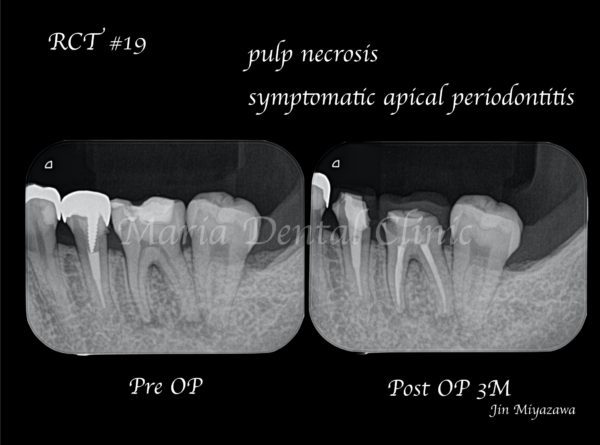 目白マリア歯科【症例】初回根管治療（歯髄壊死）｜患者様利益を考えた精密根管治療_治療後_術前術後の比較レントゲン画像