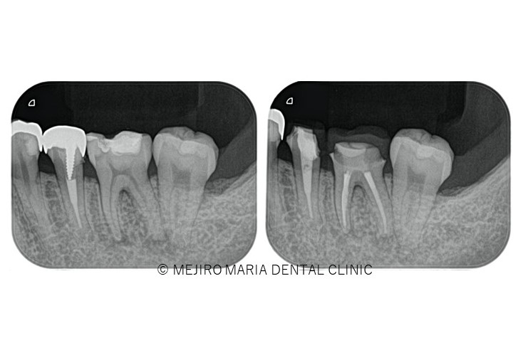 目白マリア歯科精密根管治療症例抜髄0422メイン