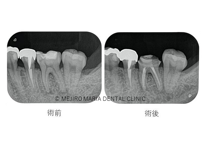 目白マリア歯科精密根管治療症例抜髄0422治療後