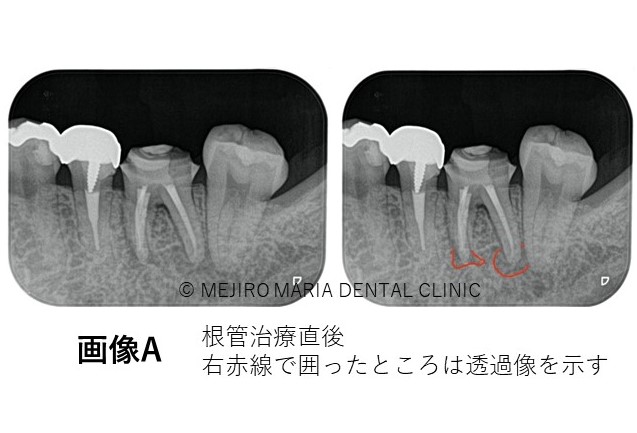 目白マリア歯科精密根管治療症例抜髄0422治療後A