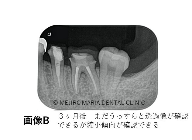 目白マリア歯科精密根管治療症例抜髄0422治療後B