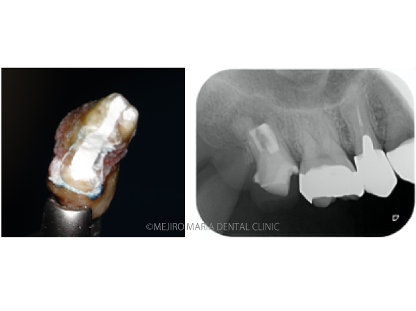 目白マリア歯科_意図的再植術0625メイン