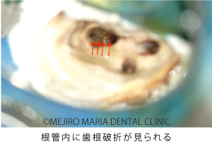 目白マリア歯科_意図的再植術0625治療前2