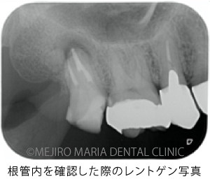 目白マリア歯科_意図的再植術0625治療前3