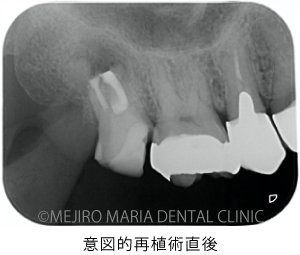 目白マリア歯科_意図的再植術0625治療後1