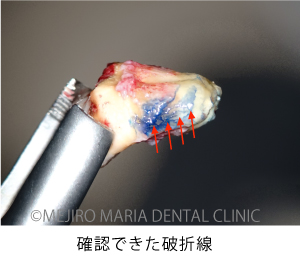 目白マリア歯科_意図的再植術0625治療詳細1
