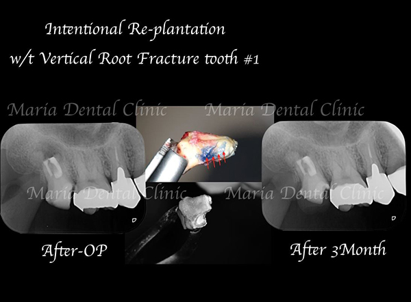 目白マリア歯科【症例】意図的再植術｜歯根破折歯を保存したチャレンジケース_レントゲン写真術前術後